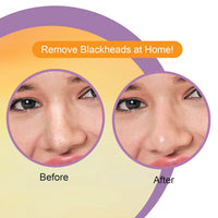 DR.Rashel Nose Pore Strips For Pore Cleansing | Deep Cleansing Nose Strips For Instant And Painless Blackheads Removal | Deep Purifying Blackhead Remover Strips for Nose | 10 PCS (Vitamin C)